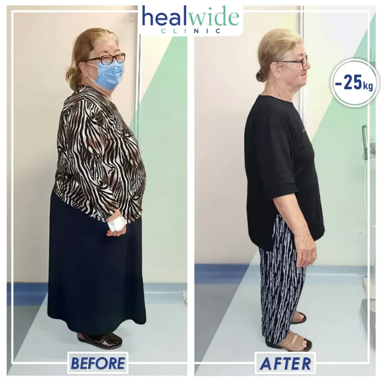 obesity-surgery-before-after