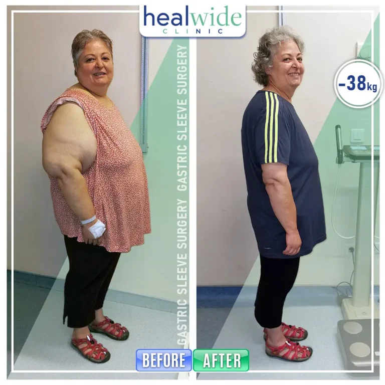 obesity-surgery-before-after