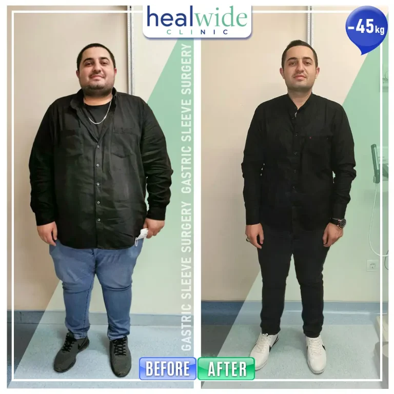 obesity-surgery-before-after