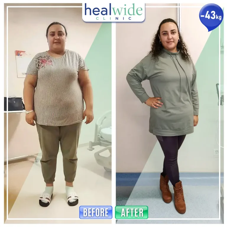 obesity-surgery-before-after
