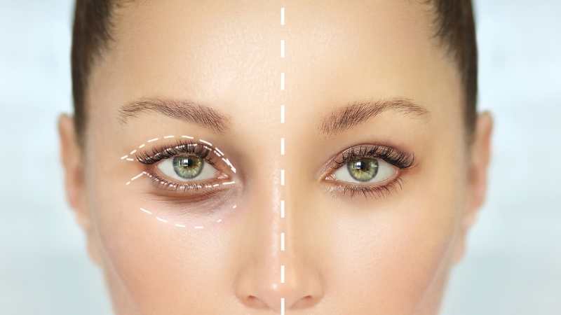 Eyelid Aesthetics in Turkey (Blepharoplasty)