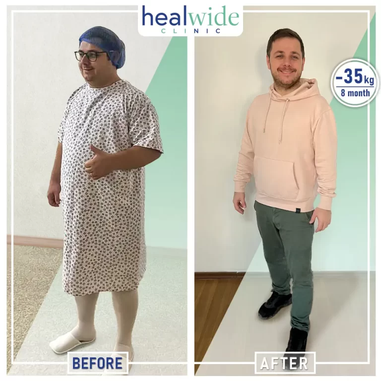 weight-loss-surgery-before-after