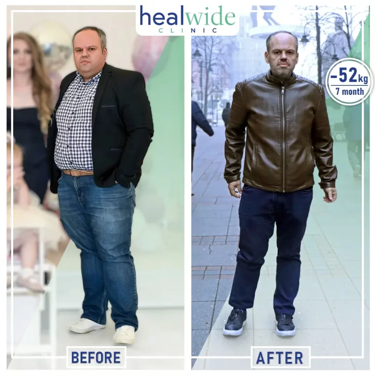 weight-loss-surgery-before-after