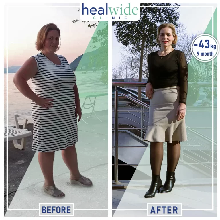 weight-loss-surgery-before-after