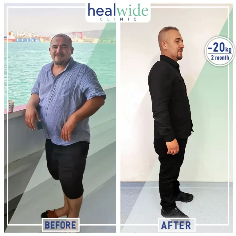 weight-loss-surgery-before-after