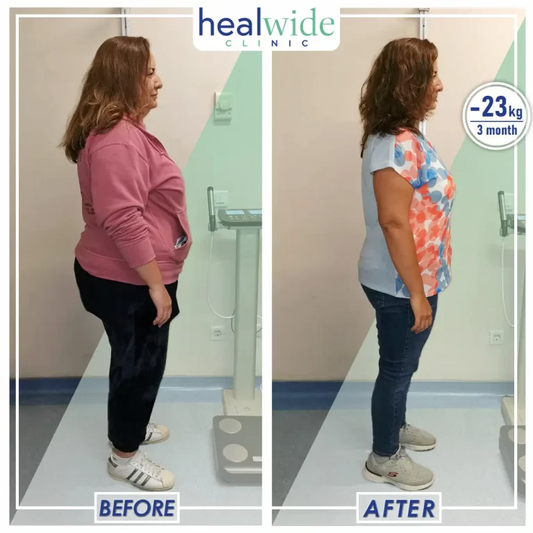 weight-loss-surgery-before-after