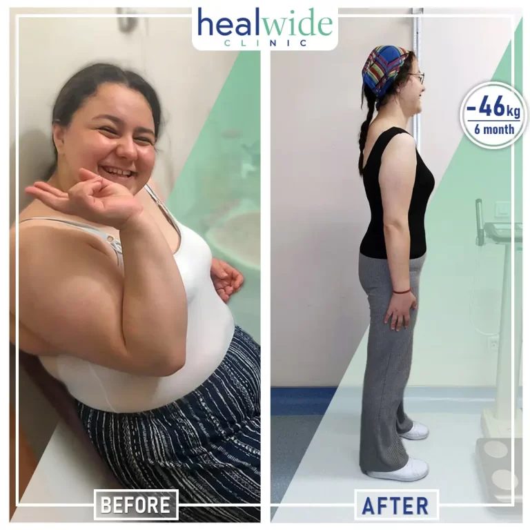 weight-loss-surgery-before-after