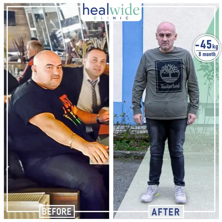 weight-loss-surgery-before-after