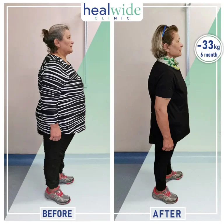 weight-loss-surgery-before-after