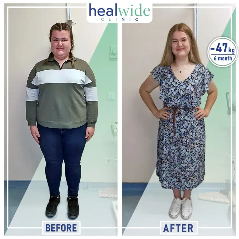 weight-loss-surgery-before-after