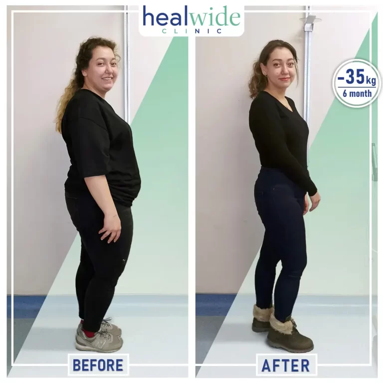 weight-loss-surgery-before-after