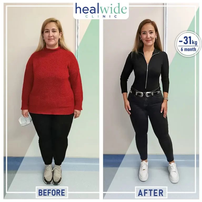 weight-loss-surgery-before-after