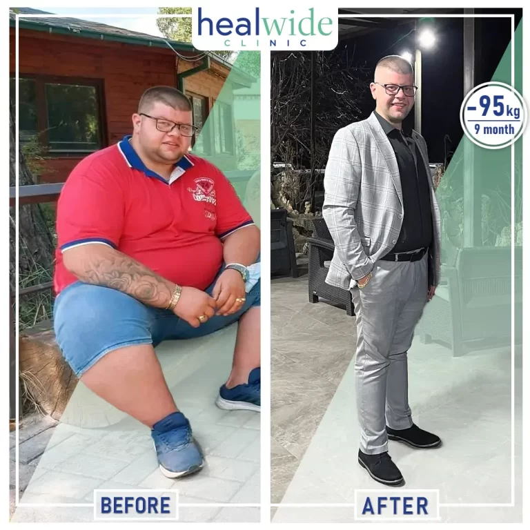 weight-loss-surgery-before-after