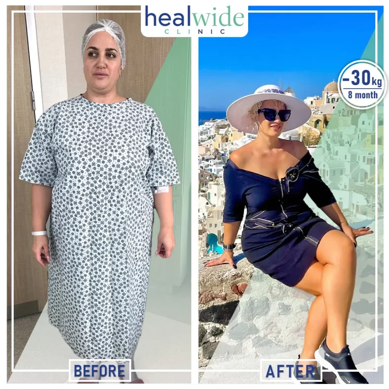 weight-loss-surgery-before-after