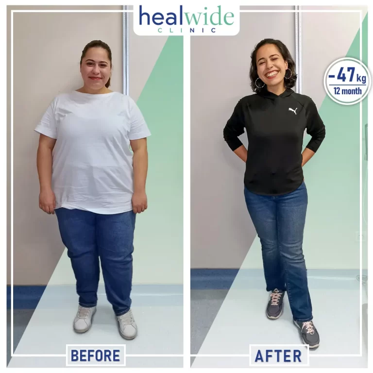 gastric-sleeve-before-after
