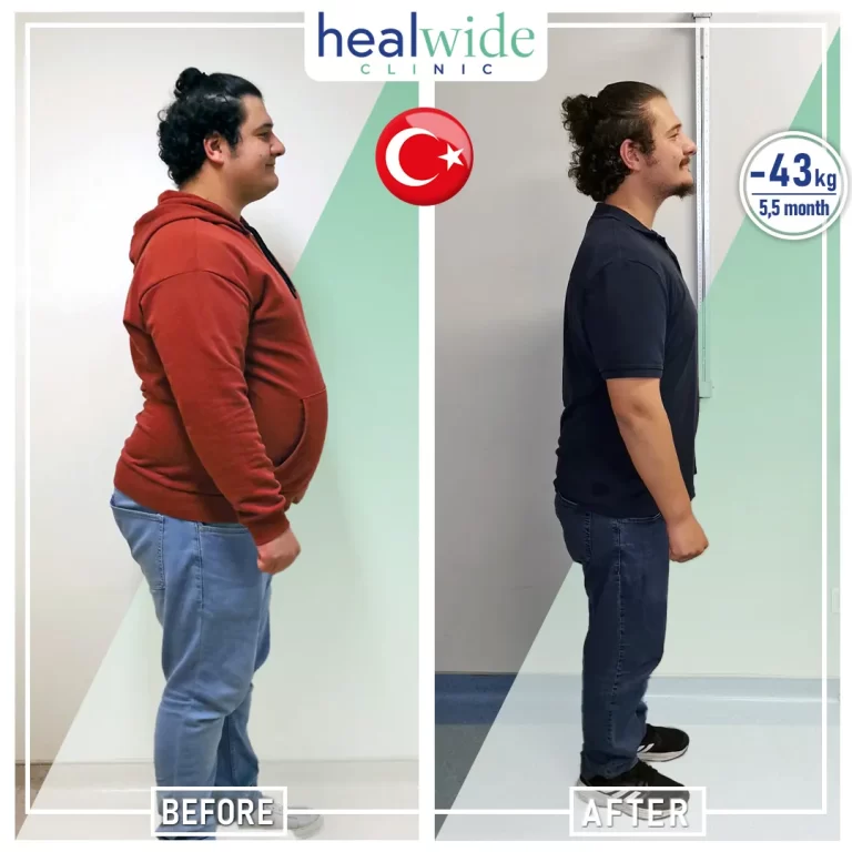 gastric-sleeve-before-after