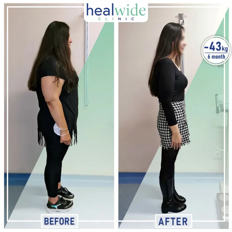 gastric-sleeve-before-after-3