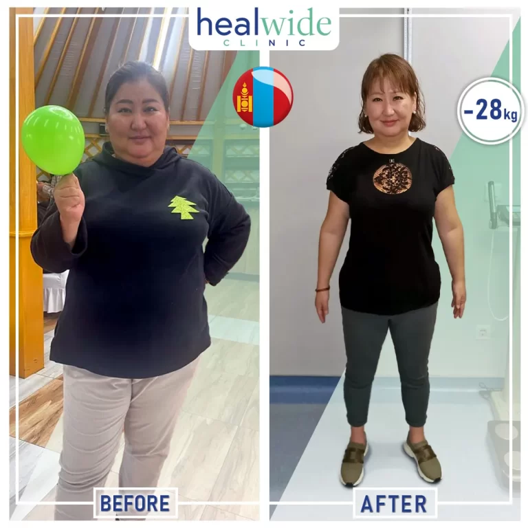 gastric-sleeve-before-after